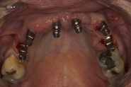 11-impression-posts-placed-showing-angulation-of-implant-fixtures