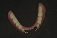 11-new-lower-denture-fabricated