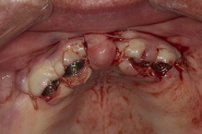 3-surgical-implant-site-closed-immediately-postoperatively