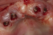 4-implant-fixtures-exposed-after-soft-tissue-healing-of-8-weeks