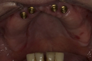8-healed-locator-abutments-and-residual-lower-teeth