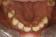 3-mirror-view-of-failing-teeth