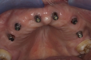 9-permanent-syncone-abutments-fitted-and-healed