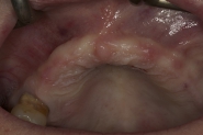 1-preoperative-view-of-missing-upper-teeth