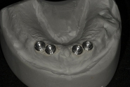 11-implant-overdenture-model