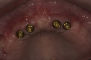 16-implant-overdenture-abutments-healed-in-situ-4-weks-later