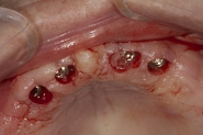 8-implant-fixtures-exposed