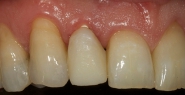 6-implant-temporary-crown-fitted