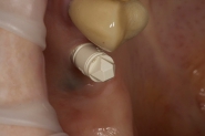 5-itero-implant-scan-body-in-situ