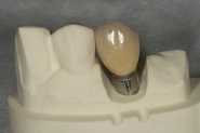 7-implant-crown-made-on-itero-model