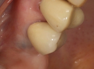 9-implant-crown-fitted