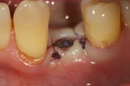 4-implant-surgical-site-closed