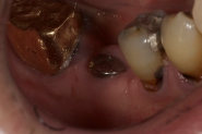 5-healed-implant-healing-abutment-post-placement