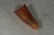 2-split-tooth-root