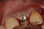 5-implant-site-closed