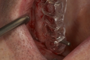 10-surgical-guide-in-situ-to-aid-in-correct-implant-positioning