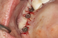13-healing-abutments-placed-and-implant-site-closed