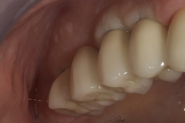 22-retracted-view-of-permanent-implant-crowns-tried-in-situ