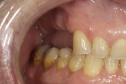 4-right-side-preoperative-view-of-missing-and-worn-teeth