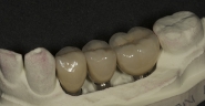 9-implant-crown-restorations-in-place