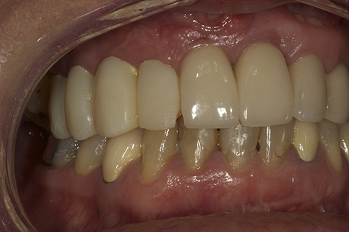 Case Study on Chipped Lower Teeth in Manchester, MO