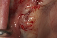 10-implant-site-sutured-closed