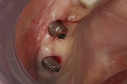 16-permanent-abutments-tried-in