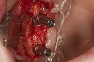 7-implants-placed-in-situ