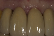 11-post-op-retracted-front-teeth