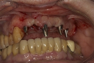6-failing-teeth-extracted-permanent-abutments-connected-to-implants