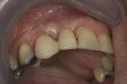 15-implant-bridge-fited-in-relation-to-adjacent-teeth