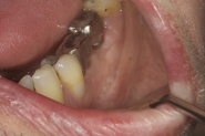 11-metal-framework-of-permanent-crowns-impressioned-in-situ-to-fabricate-exact-permanent-implant-crowns