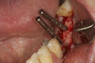 3-direction-indicators-used-to-ensure-correct-angulation-of-prepared-site-for-implant-placement