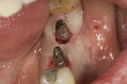 8-implant-fixtures-exposed-and-permanent-abutments-tried-in