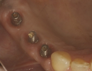13-mirror-view-of-implant-abutments-and-their-emergence-profile