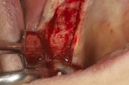 2-implant-site-exposed