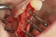3-implant-direction-indicators-used-to-ensure-exact-angulations-of-prepared-implant-bed