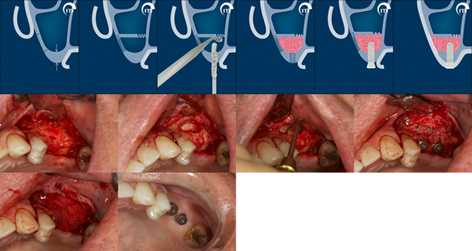 Case Study showing Simultaneous Implant Placement and Sinus Augmentation/Lift