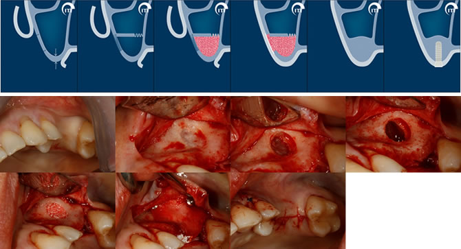 Case Study showing Delayed Implant Placement following Sinus Augmentation/Lift