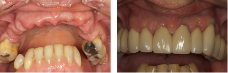 Replacement of Full Upper Arch with Implant-retained Fixed Bridge (cemented in):