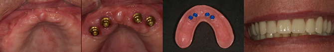 Replacement of Full Upper Arch with Implant-retained Denture: