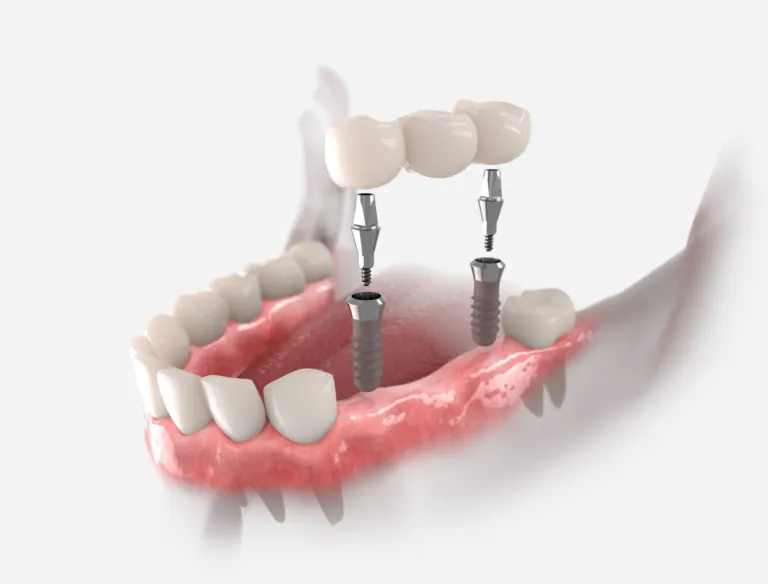3D illustration of a bridge of three teeth being fixed onto two implants in the lower jaw