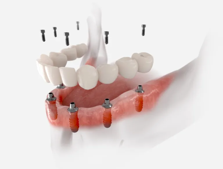 3D illustration of a full arch of teeth being fixed onto implants in the lower jaw