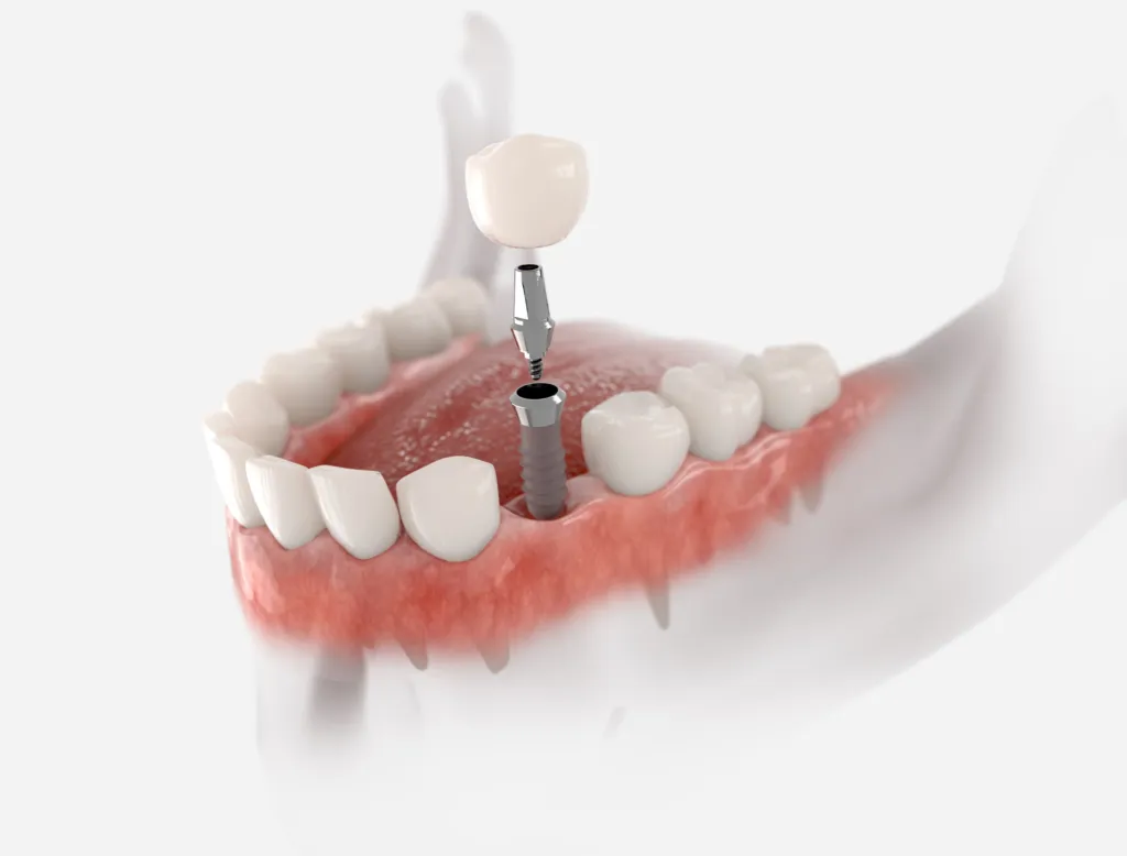 3D illustration of a lower jaw with one missing tooth, showing the implant, abutment and crown that replace it