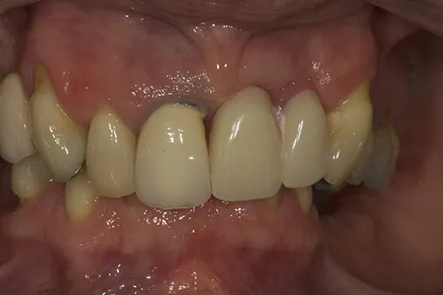 Before treatment: Replacing failing upper teeth with a fixed implant bridge
