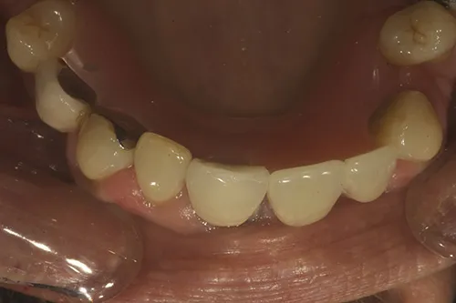 Mirror view of upper immediate denture and failing teeth