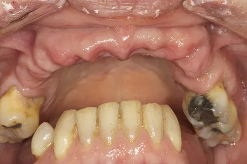 Picture of healed gums following extraction of failing teeth