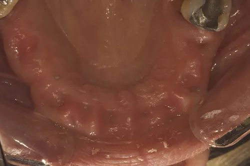 Mirror view of post extraction healed site