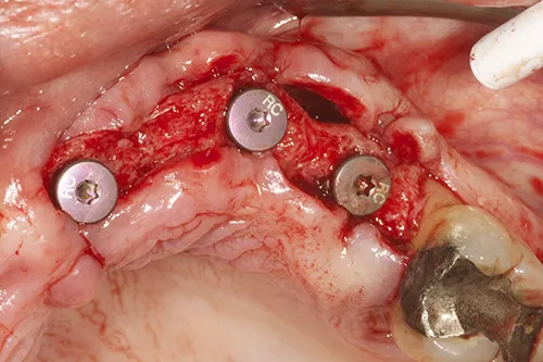Implants placed upper left hand side