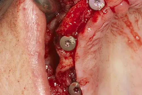 Implants placed at upper right hand side